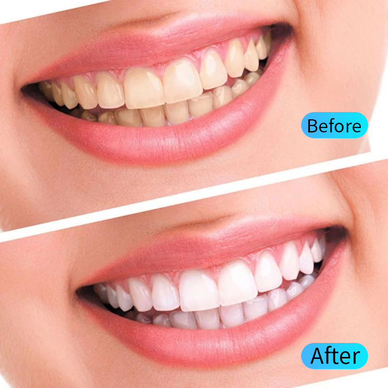 ชุดเจลฟอกสีฟัน Oral Hygiene Ca - Teeth Whitening Filter บทวิจารณ์และราคา