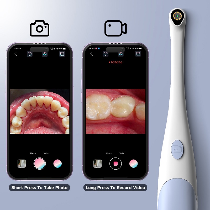 กล้องเอนโดสโคปสำหรับตรวจช่องปา - Teeth Whitening Video บทวิจารณ์และราคา