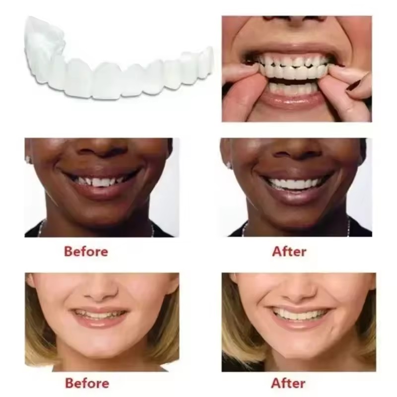 วีเนียร์ฟัน ฟอกสีฟัน ฟันปลอม ท - Teeth Whitening Session บทวิจารณ์และราคา
