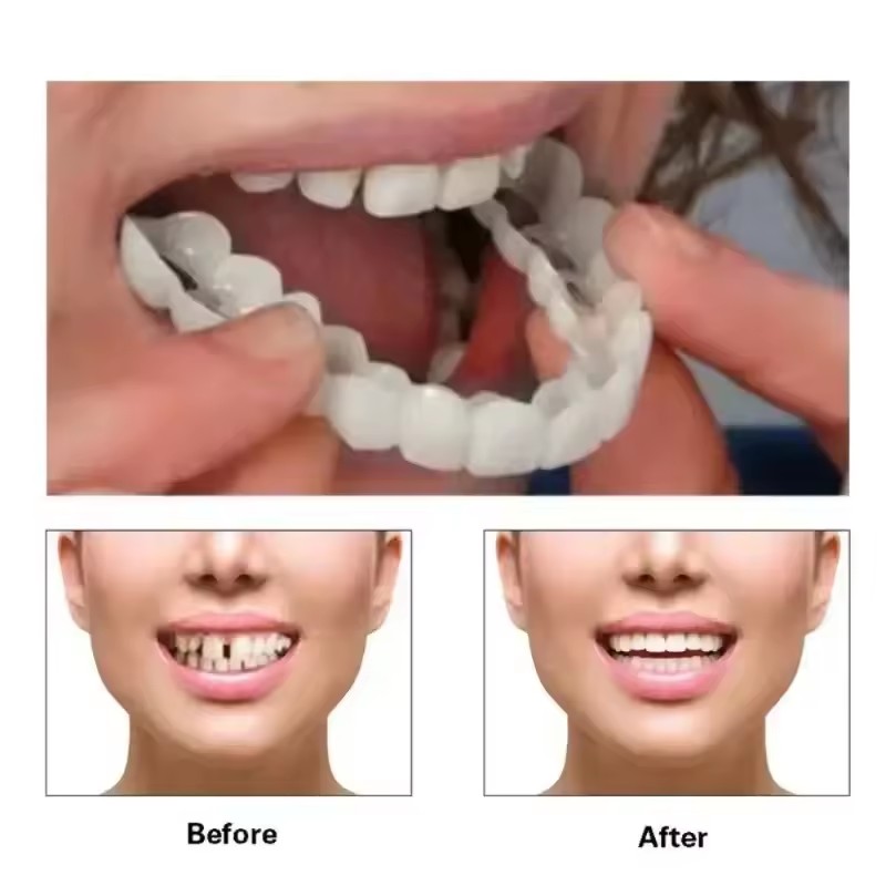 วีเนียร์ฟัน ฟอกสีฟัน ฟันปลอม ท - Teeth Whitening Session บทวิจารณ์และราคา