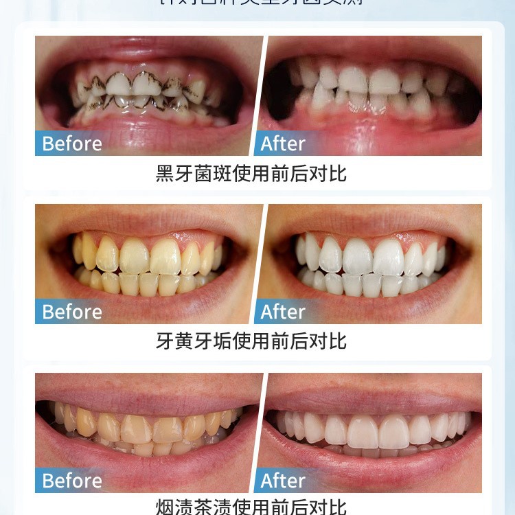 ญี่ปุ่นคู่มือฟันแปรงกําจัดคราบ - Teeth Whitening In Japan บทวิจารณ์และราคา